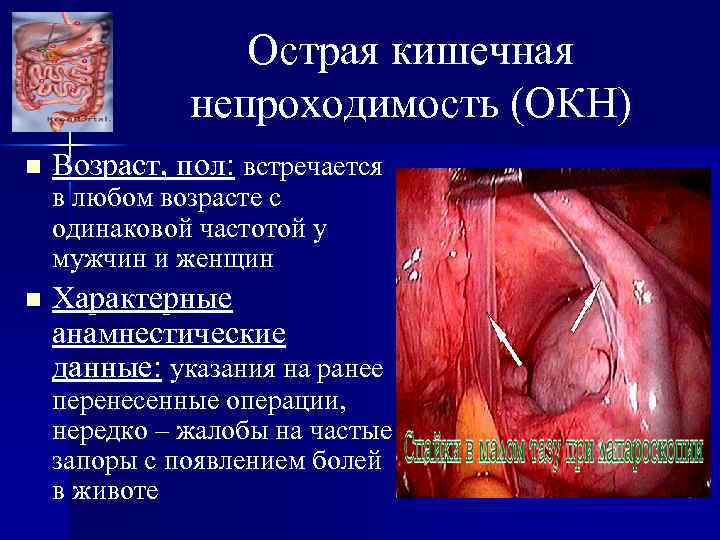 Острая кишечная непроходимость (ОКН) n Возраст, пол: встречается в любом возрасте с одинаковой частотой
