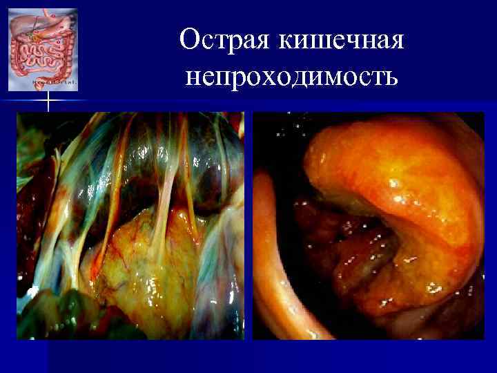 Острая кишечная непроходимость 