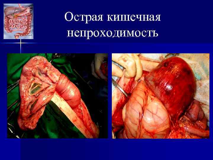 Острая кишечная непроходимость 