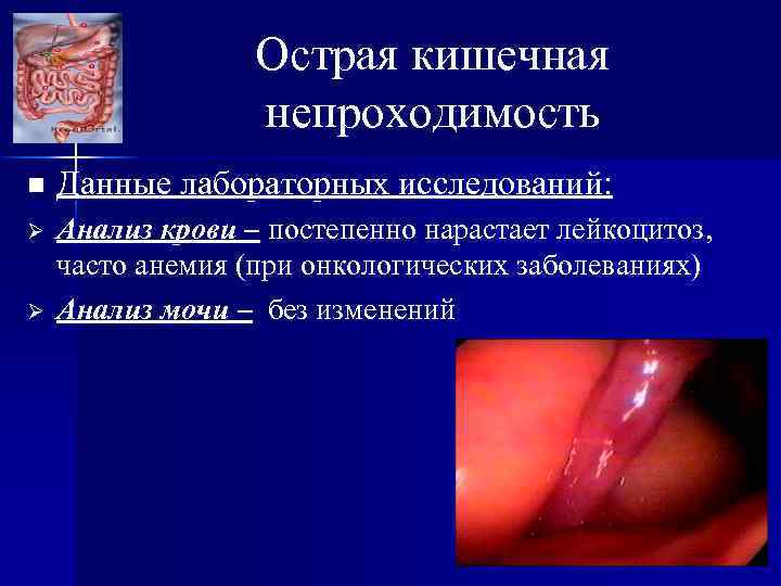 Острая кишечная непроходимость n Данные лабораторных исследований: Ø Анализ крови – постепенно нарастает лейкоцитоз,