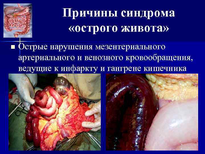 Причины синдрома «острого живота» n Острые нарушения мезентериального артериального и венозного кровообращения, ведущие к