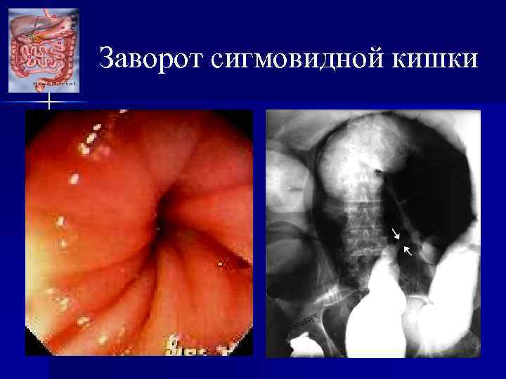 Заворот сигмовидной кишки 