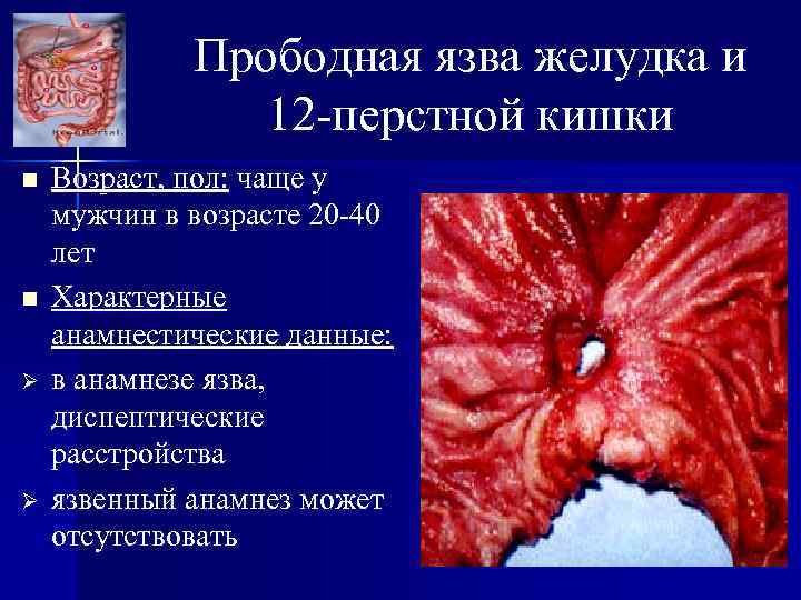 Прободная язва желудка и 12 -перстной кишки n n Ø Ø Возраст, пол: чаще