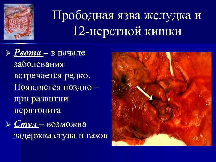 Прободная язва желудка и 12 -перстной кишки Рвота – в начале заболевания встречается редко.