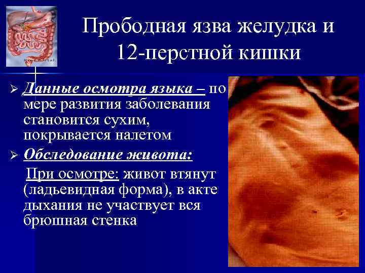 Прободная язва желудка и 12 -перстной кишки Данные осмотра языка – по мере развития