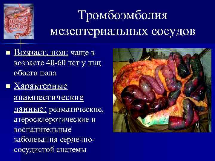 Тромбоэмболия мезентериальных сосудов n Возраст, пол: чаще в возрасте 40 -60 лет у лиц