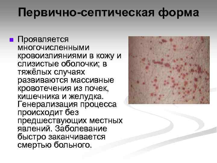 Первично-септическая форма n Проявляется многочисленными кровоизлияниями в кожу и слизистые оболочки; в тяжёлых случаях