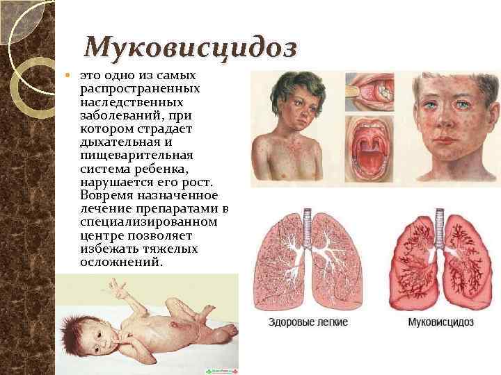 Муковисцидоз это одно из самых распространенных наследственных заболеваний, при котором страдает дыхательная и пищеварительная