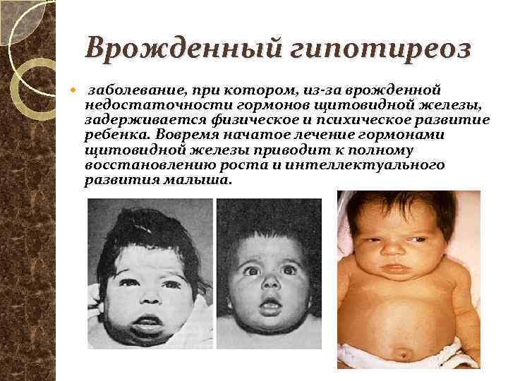 Врожденный гипотиреоз заболевание, при котором, из-за врожденной недостаточности гормонов щитовидной железы, задерживается физическое и