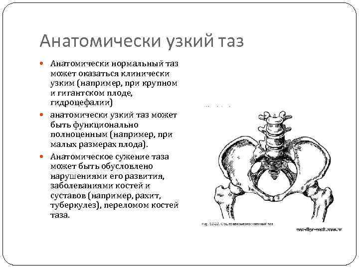 Анатомически узкий таз Анатомически нормальный таз может оказаться клинически узким (например, при крупном и