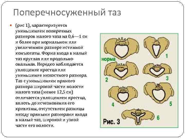 Поперечносуженный таз (рис 1), характеризуется уменьшением поперечных размеров малого таза на 0, 6— 1