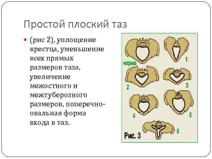 Гинекоидный таз. Формы узкого таза в акушерстве. Классификация сужения таза. Редко встречающиеся формы узкого таза. Плоский узкий таз.