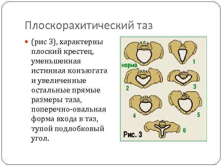 Плоскорахитический таз (рис 3), характерны плоский крестец, уменьшенная истинная конъюгата и увеличенные остальные прямые