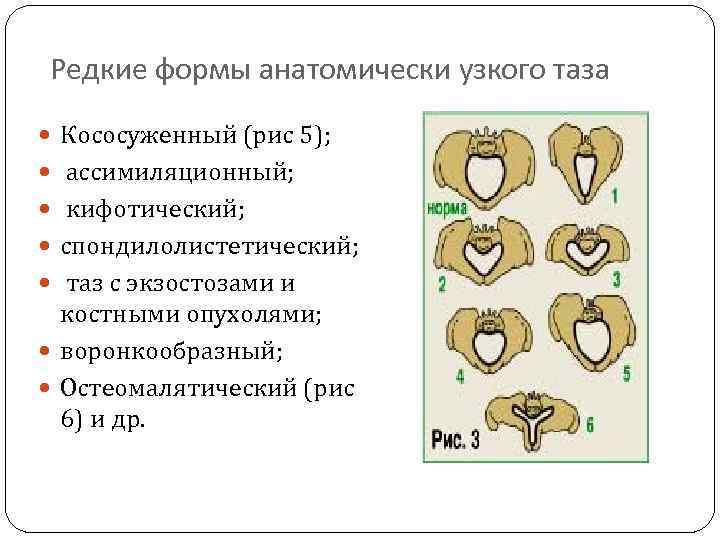 Анатомический узкий таз в акушерстве презентация