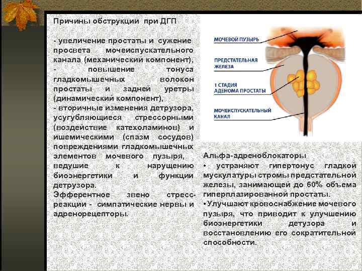 Причины обструкции при ДГП увеличение простаты и сужение просвета мочеиспускательного канала (механический компонент), повышение