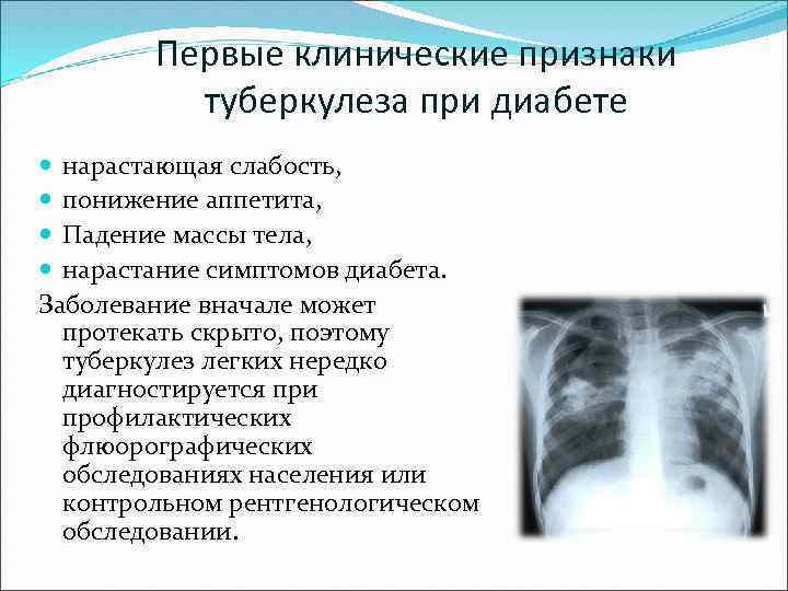 Первые клинические признаки туберкулеза при диабете нарастающая слабость, понижение аппетита, Падение массы тела, нарастание