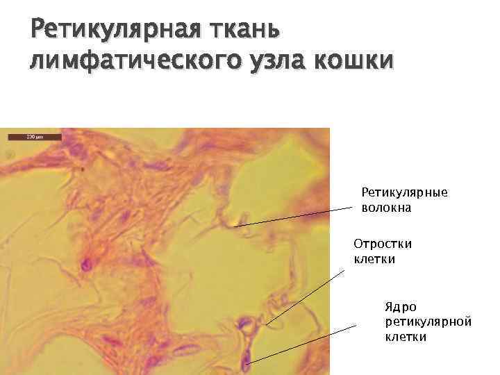 Склероз лимфоидной ткани