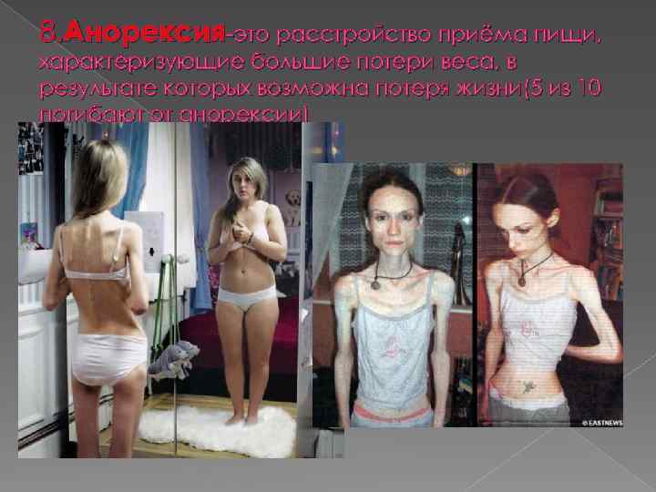 8. Анорексия-это расстройство приёма пищи, характеризующие большие потери веса, в результате которых возможна потеря