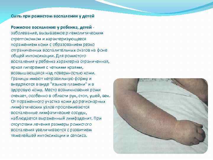 Сыпь при рожистом воспалении у детей Рожистое воспаление у ребенка, детей - заболевание, вызываемое