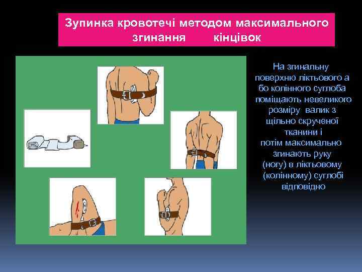 Зупинка кровотечі методом максимального згинання кінцівок. На згинальну поверхню ліктьового а бо колінного суглоба