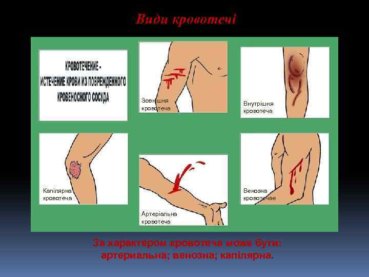 Види кровотечі Зовнішня кровотеча Капілярна кровотеча Внутрішня кровотеча Венозна кровотечае Артеріальна кровотеча За характером