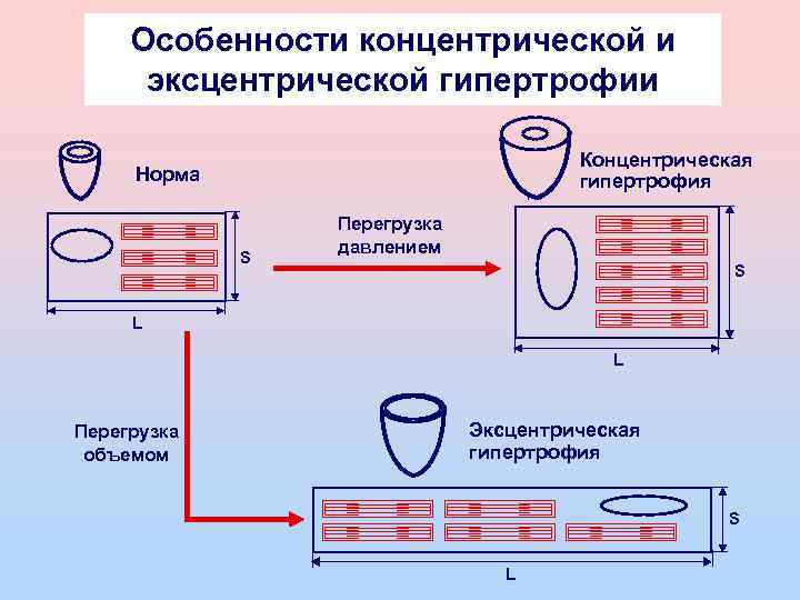 Особенности концентрической и эксцентрической гипертрофии Концентрическая гипертрофия Норма S Перегрузка давлением S L L