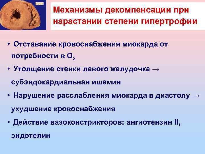 Механизмы декомпенсации при нарастании степени гипертрофии • Отставание кровоснабжения миокарда от потребности в О