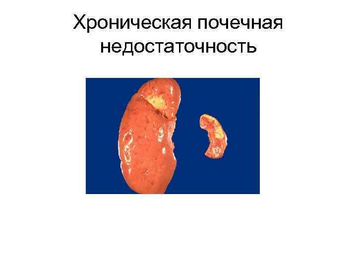 Хроническая почечная недостаточность 