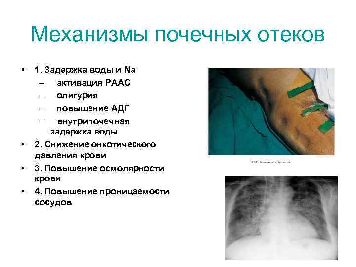 Механизмы почечных отеков • • 1. Задержка воды и Na – активация РААС –