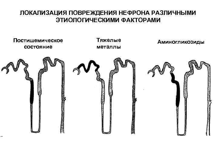 ЛОКАЛИЗАЦИЯ ПОВРЕЖДЕНИЯ НЕФРОНА РАЗЛИЧНЫМИ ЭТИОЛОГИЧЕСКИМИ ФАКТОРАМИ Постишемическое состояние Тяжелые металлы Аминогликозиды 