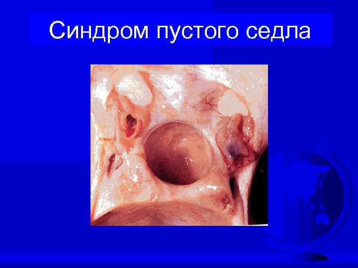 Синдром пустого седла 