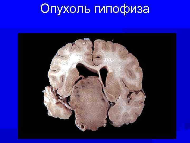 Опухоль гипофиза 