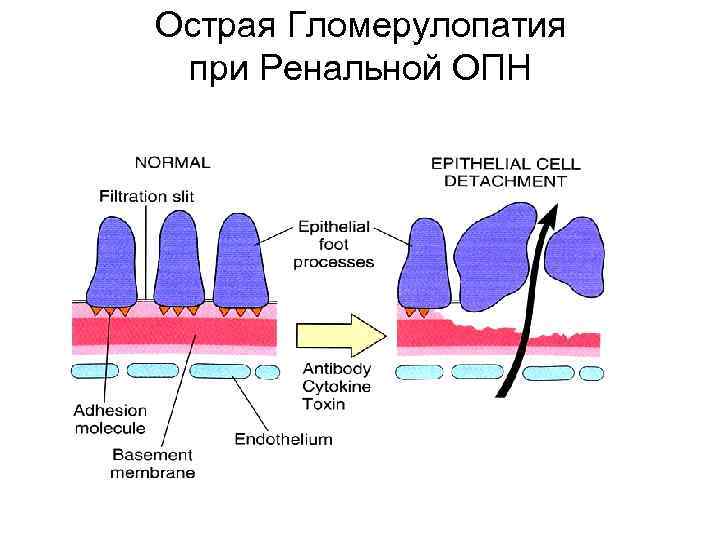 Острая Гломерулопатия при Ренальной ОПН 
