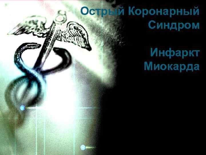 Острый Коронарный Синдром Инфаркт Миокарда 