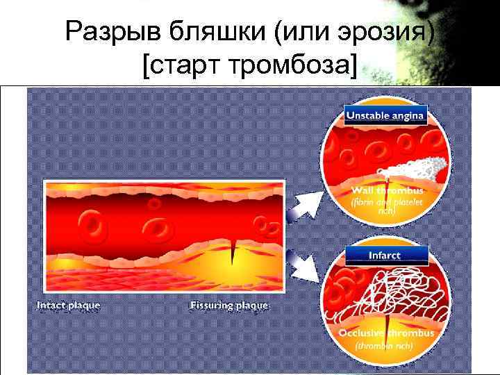 Разрыв бляшки (или эрозия) [старт тромбоза] 
