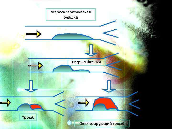 атеросклеротическая бляшка Разрыв бляшки Тромб Окклюзирующий тромб 
