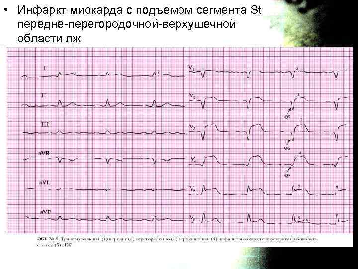 Карта вызова окс без подъема сегмента st