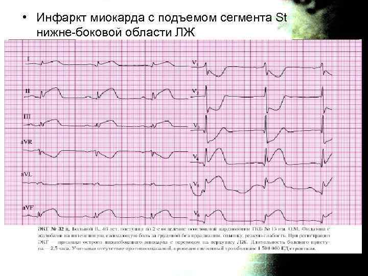 Инфаркт миокарда карта смп