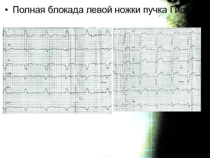  • Полная блокада левой ножки пучка Гиса 