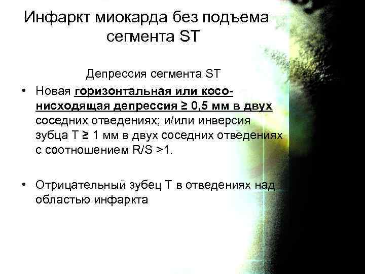 Инфаркт миокарда без подъема сегмента ST Депрессия сегмента ST • Новая горизонтальная или косонисходящая