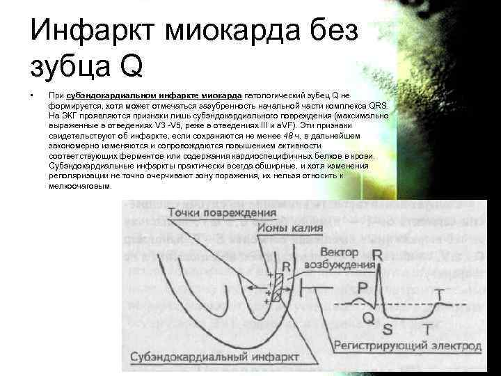 Патологический зубец q при инфаркте