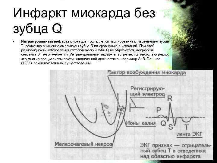 Патологический зубец q при инфаркте. ЭКГ при инфаркте миокарда без зубца q мелкоочаговый инфаркт миокарда. Инфаркт с зубцом q и без зубца q ЭКГ. Крупноочаговый инфаркт с зубцом q миокарда. Им без зубца q на ЭКГ признаки.