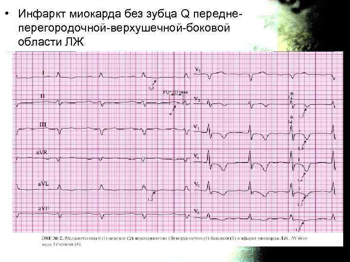 Острый инфаркт без подъема st