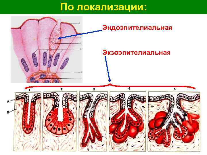 По локализации: Эндоэпителиальная Экзоэпителиальная 