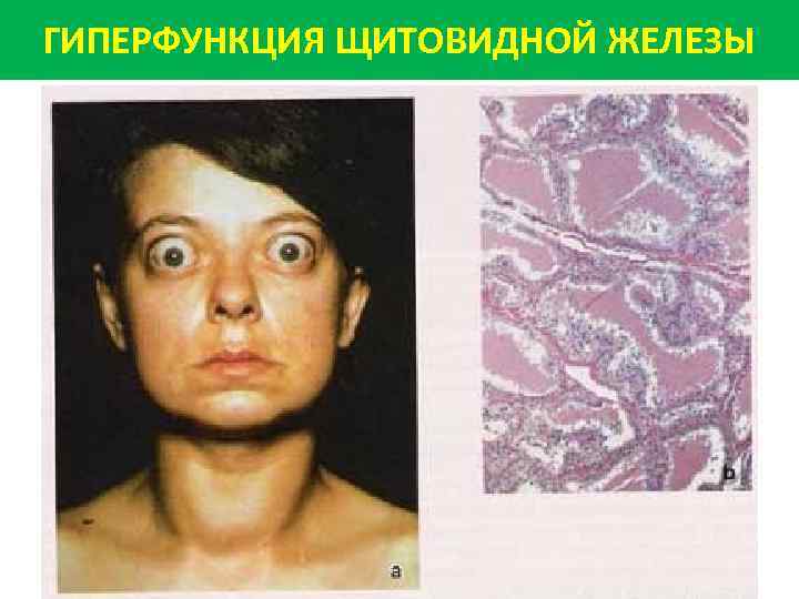 ГИПЕРФУНКЦИЯ ЩИТОВИДНОЙ ЖЕЛЕЗЫ 
