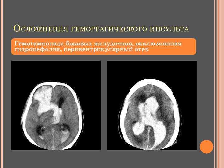 ОСЛОЖНЕНИЯ ГЕМОРРАГИЧЕСКОГО ИНСУЛЬТА Гемотампонада боковых желудочков, окклюзионная гидроцефалия, перивентрикулярный отек 