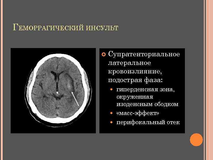 ГЕМОРРАГИЧЕСКИЙ ИНСУЛЬТ Супратенториальное латеральное кровоизлияние, подострая фаза: гиперденсная зона, окруженная изоденсным ободком «масс-эффект» перифокальный