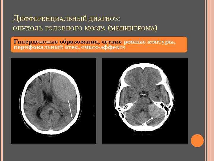 ДИФФЕРЕНЦИАЛЬНЫЙ ДИАГНОЗ: ОПУХОЛЬ ГОЛОВНОГО МОЗГА (МЕНИНГЕОМА) Гиперденсные образования, четкие ровные контуры, перифокальный отек, «масс-эффект»