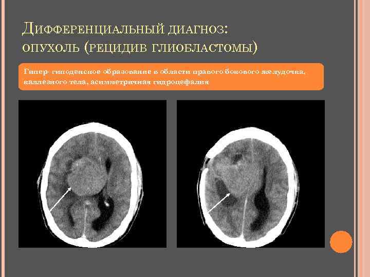 ДИФФЕРЕНЦИАЛЬНЫЙ ДИАГНОЗ: ОПУХОЛЬ (РЕЦИДИВ ГЛИОБЛАСТОМЫ) Гипер- гиподенсное образование в области правого бокового желудочка, каллезного