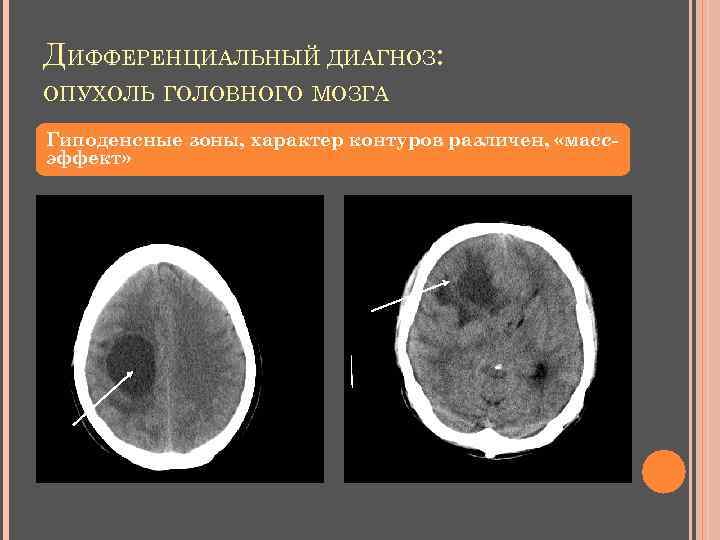 ДИФФЕРЕНЦИАЛЬНЫЙ ДИАГНОЗ: ОПУХОЛЬ ГОЛОВНОГО МОЗГА Гиподенсные зоны, характер контуров различен, «массэффект» 